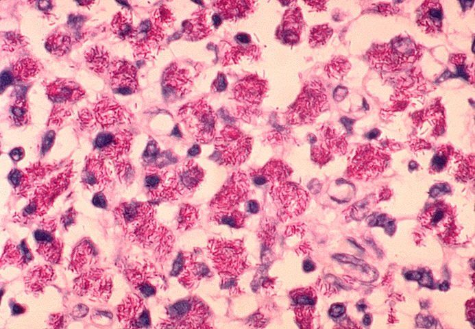 Mycobacterium avium complex (Gram positive)